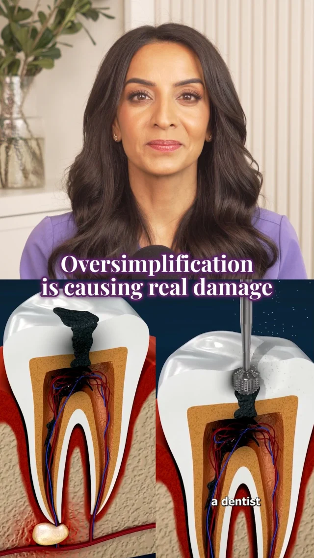 This is one of the biggest problems with dental content online:

Oversimplified animations create oversimplified beliefs.

Yes, this gives a basic idea of what a root canal is.
But modern endodontics is far more precise than most people realize.

We’re not “hollowing out” teeth.
We’re working within microscopic anatomy, preserving as much natural tooth structure as possible while disinfecting complex canal systems that are different in every single patient.

And that nuance matters.

Because a carefully performed root canal with proper magnification, imaging, disinfection, and technique is completely different from a rushed procedure done without the right tools.

The procedure isn’t the problem.
The quality of the treatment is. 🦷

#Endodontics #DentalEducation #RootCanalAwareness