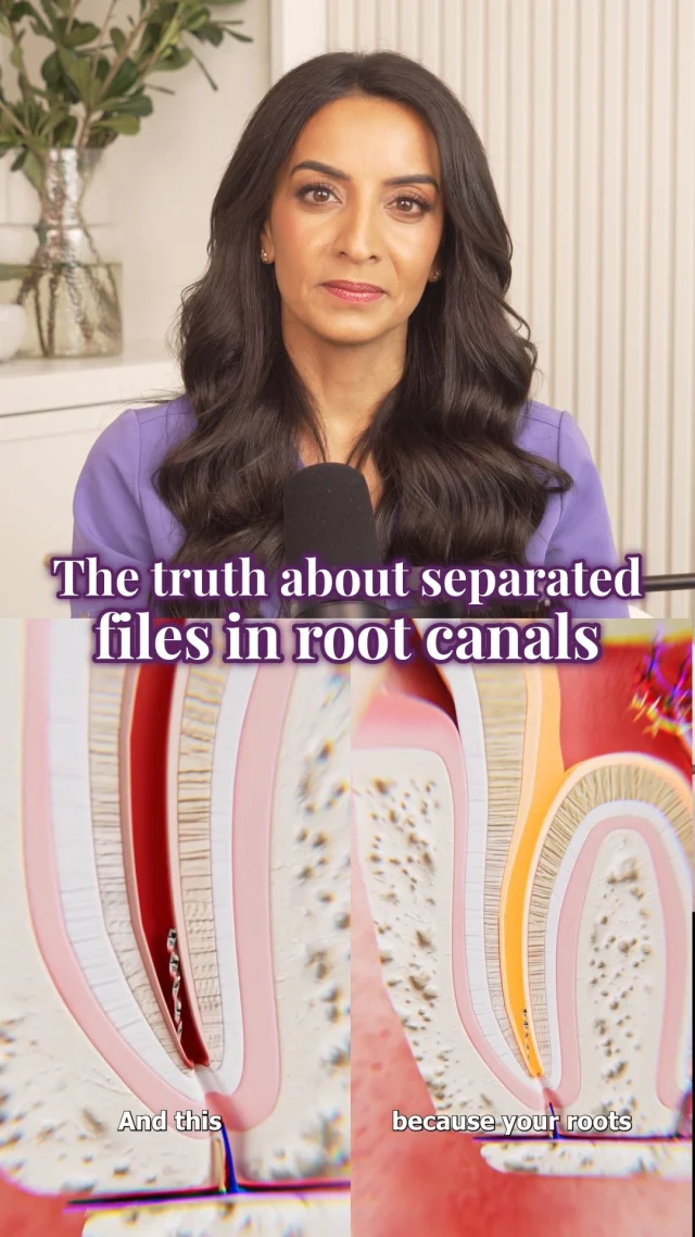 One of the biggest problems with dental content online is when real risks are explained without proper context.

Yes, file separation can happen during a root canal.
It’s a known procedural risk, especially in curved or calcified canals with difficult anatomy.

But a separated file does not automatically mean the tooth is failing or dangerous.

What matters is the overall disinfection of the canal system, the location of the fragment, and the quality of the treatment around it.

And more importantly, the goal is always to minimize the risk in the first place.

That’s where training, magnification, technology, and clinical technique make a massive difference.

#Endodontics #DentalEducation #RootCanalTreatment